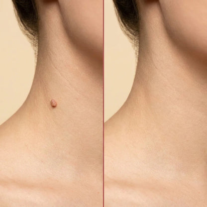 BelBexa™️  - Microneedle Skin Tag Patch (Buy 1 Get 1 Free)
