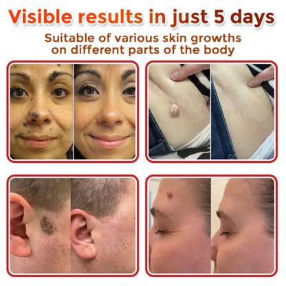 BelBexa™️  - Microneedle Skin Tag Patch (Buy 1 Get 1 Free)