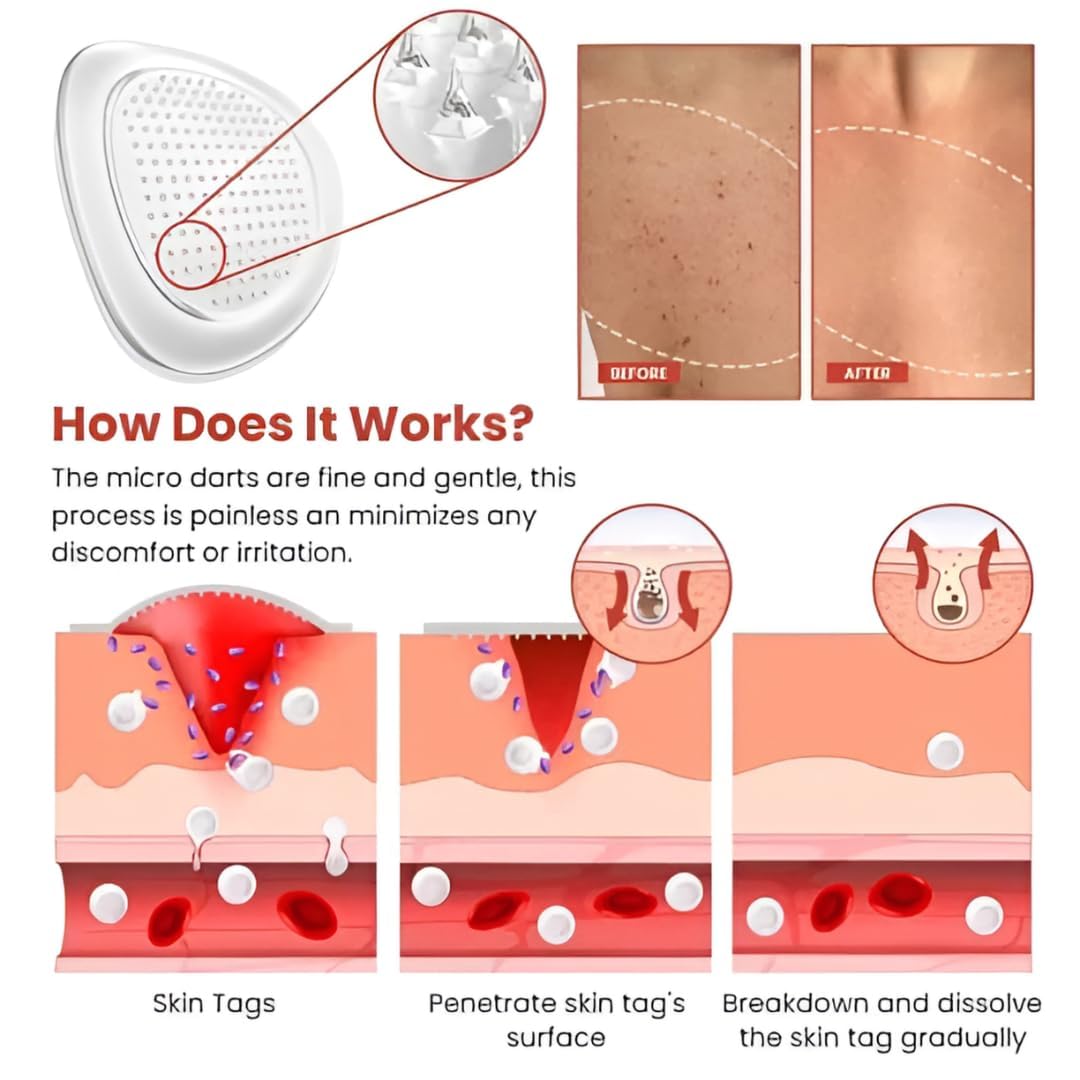 BelBexa™️  - Microneedle Skin Tag Patch (Buy 1 Get 1 Free)
