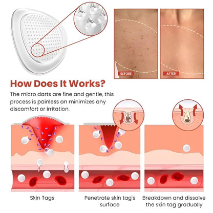 BelBexa™️  - Microneedle Skin Tag Patch (Buy 1 Get 1 Free)