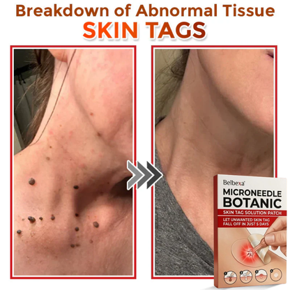 BelBexa™️  - Microneedle Skin Tag Patch (Buy 1 Get 1 Free)